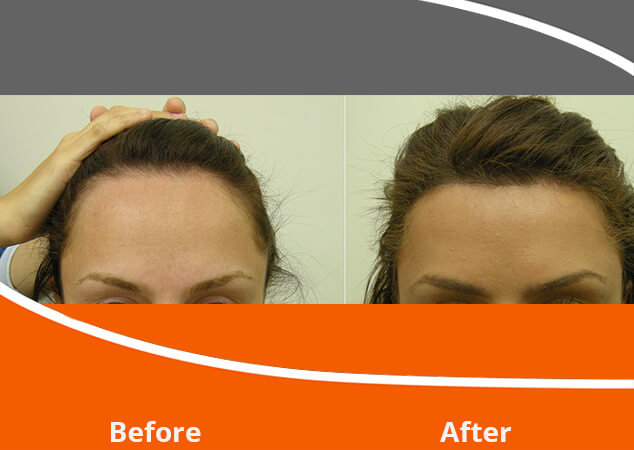 Hairline Lowering / Hairline Advancement | Norwood Day Surgery